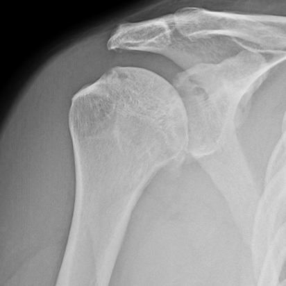 Comeback Champion: David Hall